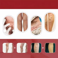 VARICOSE VEINS CREMA PARA VARICES