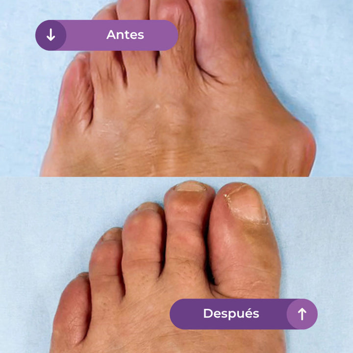 CORRECTOR DE JUANETE CORRECT FLEX